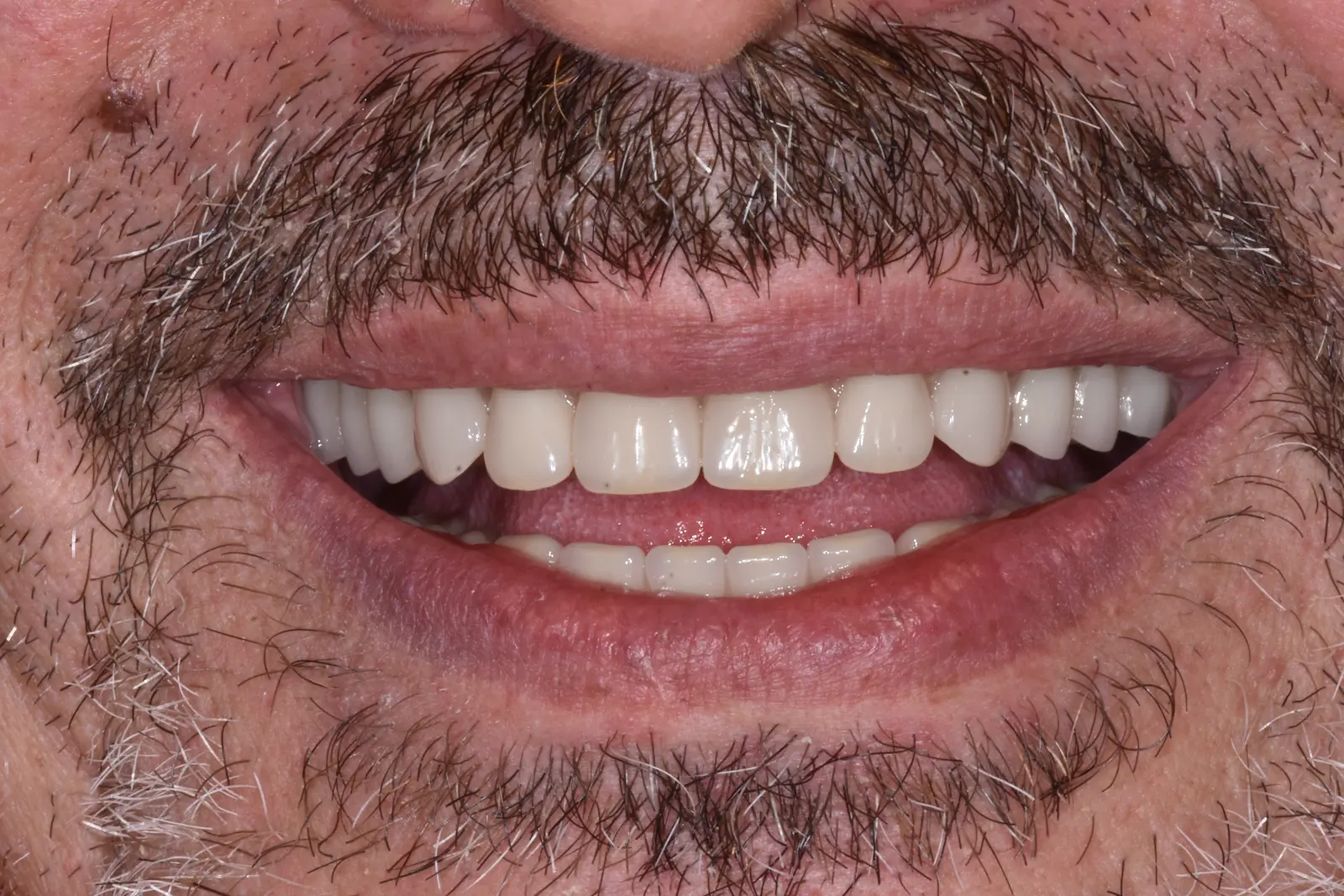 Igor dopo la riabilitazione totale su impianti allo Studio Caneva di Trieste — sorriso naturale