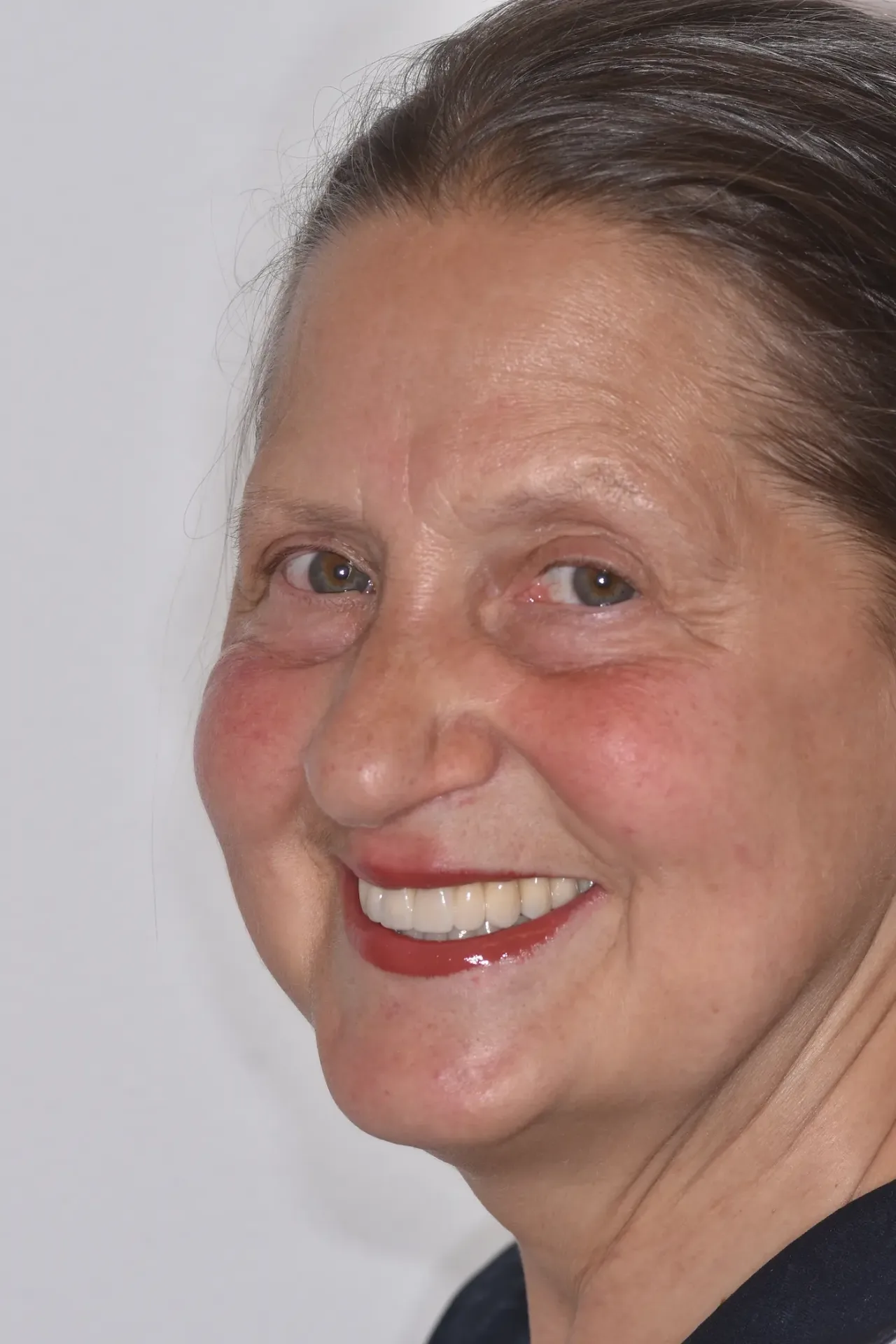Luana dopo la riabilitazione su denti e impianti allo Studio Caneva di Trieste — sorriso naturale