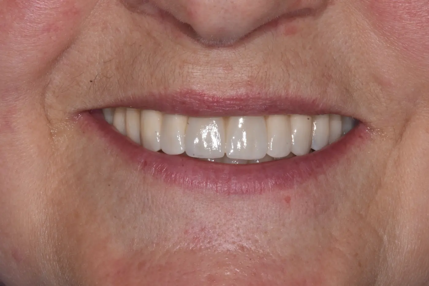 Risultato della riabilitazione di Luana: sorriso dopo impianti e corone allo Studio Caneva Trieste