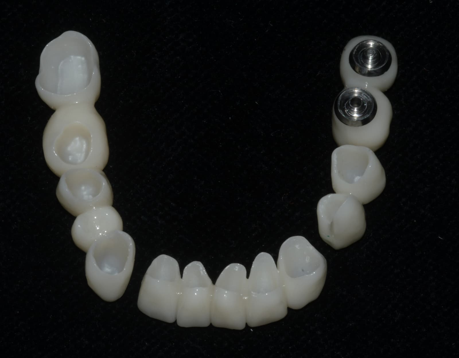 Protesi su impianti arcata inferiore — Studio Dentistico Caneva Trieste