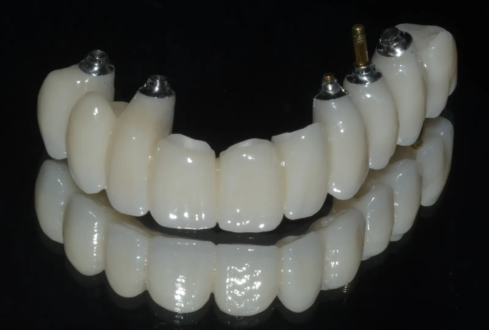 Riabilitazione completa su denti e impianti — caso clinico Studio Caneva Trieste