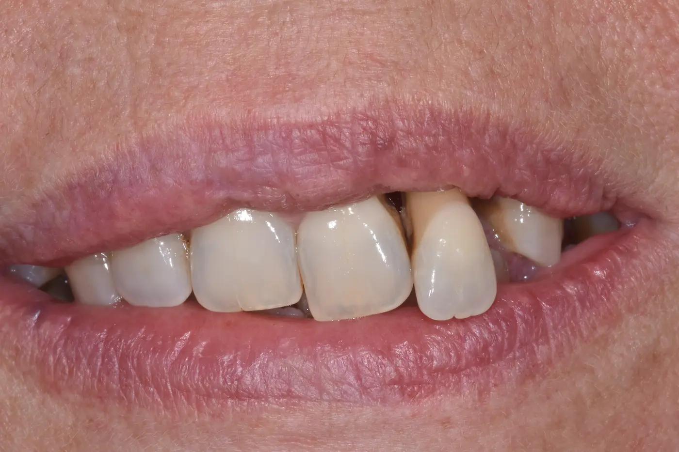 Tiziana prima della riabilitazione dentale allo Studio Caneva di Trieste — situazione iniziale