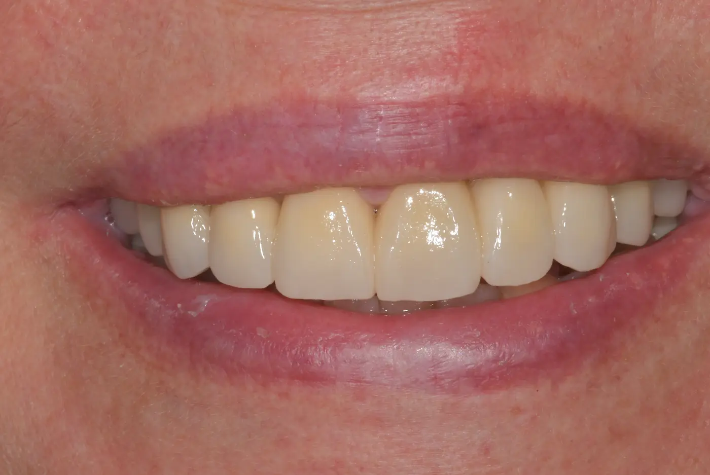 Tiziana dopo la riabilitazione su denti e impianti allo Studio Caneva — sorriso naturale